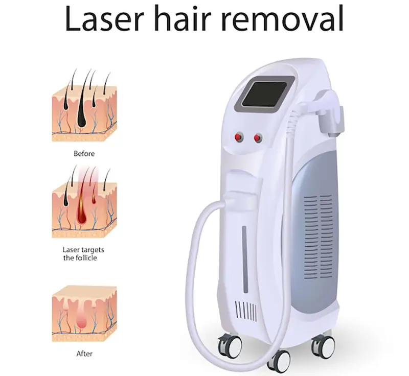 تفاوت دستگاه لیزر خانگی و کلینیکی از نظر نوع پوست و مو